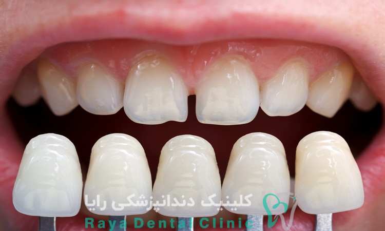 افزایش عمر کامپوزیت
