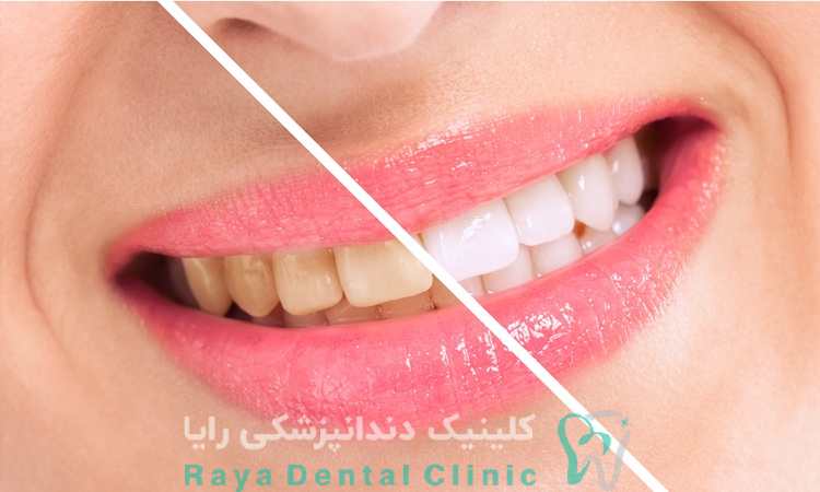 راهکارهای سفید کردن دندان