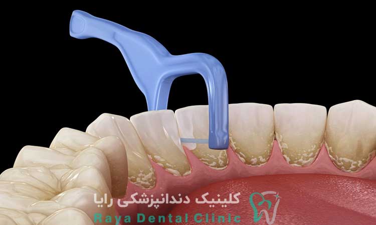 علت خراب شدن دندان